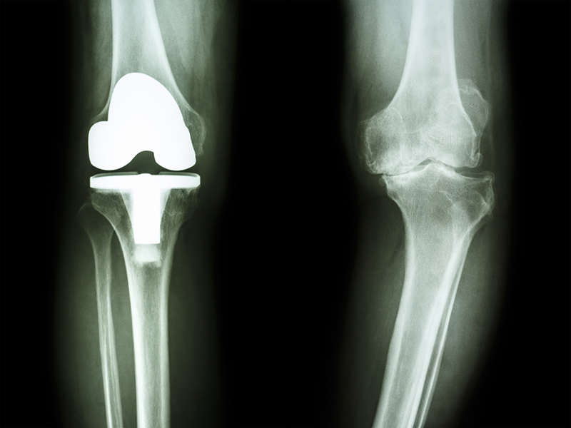 Is The Pain In Your Joints From Osteoarthritis?